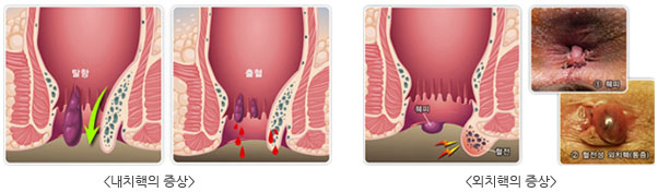 내치핵의증상  외치핵의증상